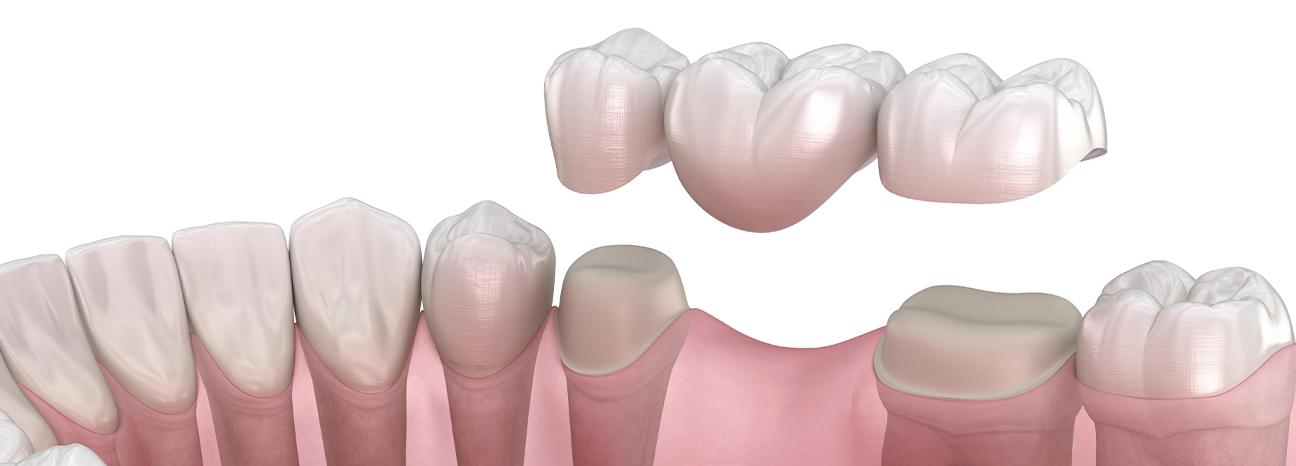 Dental Bridges | Redtree Dental | Vancouver General Dentist