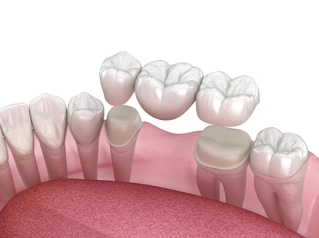Dental Bridges Treatment | Redtree Dental | Vancouver General Dentist