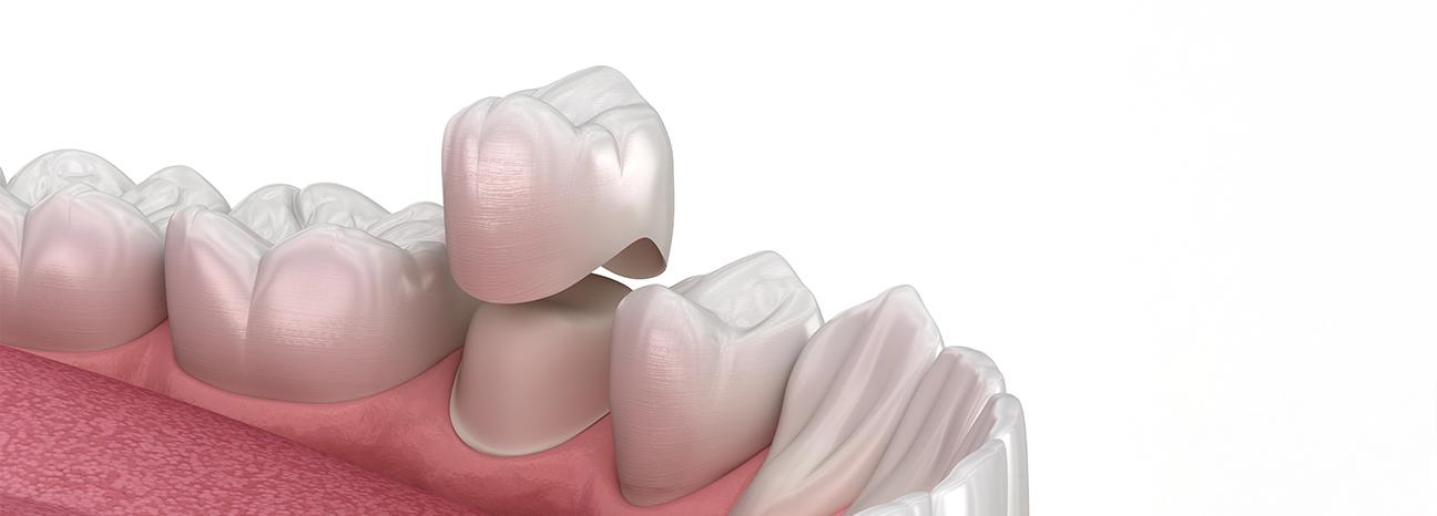 Dental Crowns | Redtree Dental | Vancouver General & Family Dentist