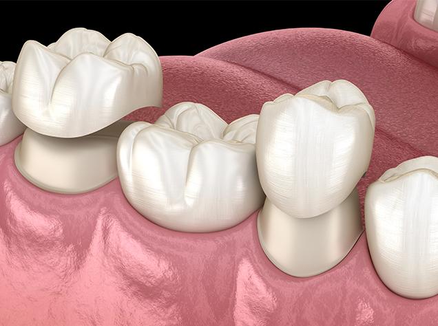 Dental Crowns | Redtree Dental | Vancouver General & Family Dentist