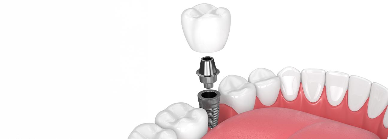 Dental Implants | Redtree Dental | Vancouver General & Family Dentist