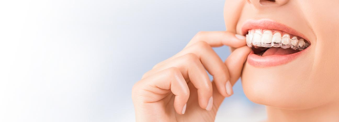 Mouthguards Treatment | Redtree Dental | Vancouver General Dentist
