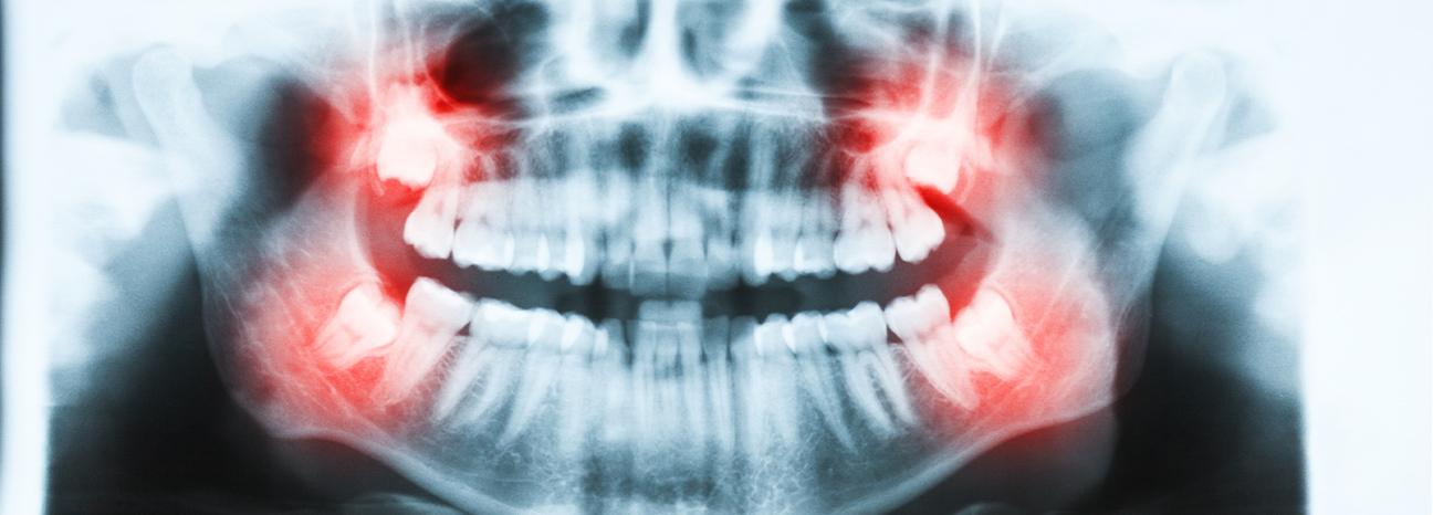Vancouver Oral Surgery | Redtree Dental | Vancouver General & Family Dentist