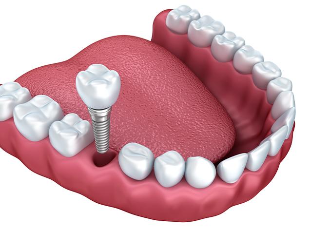 Vancouver Oral Surgery | Redtree Dental | Vancouver General & Family Dentist