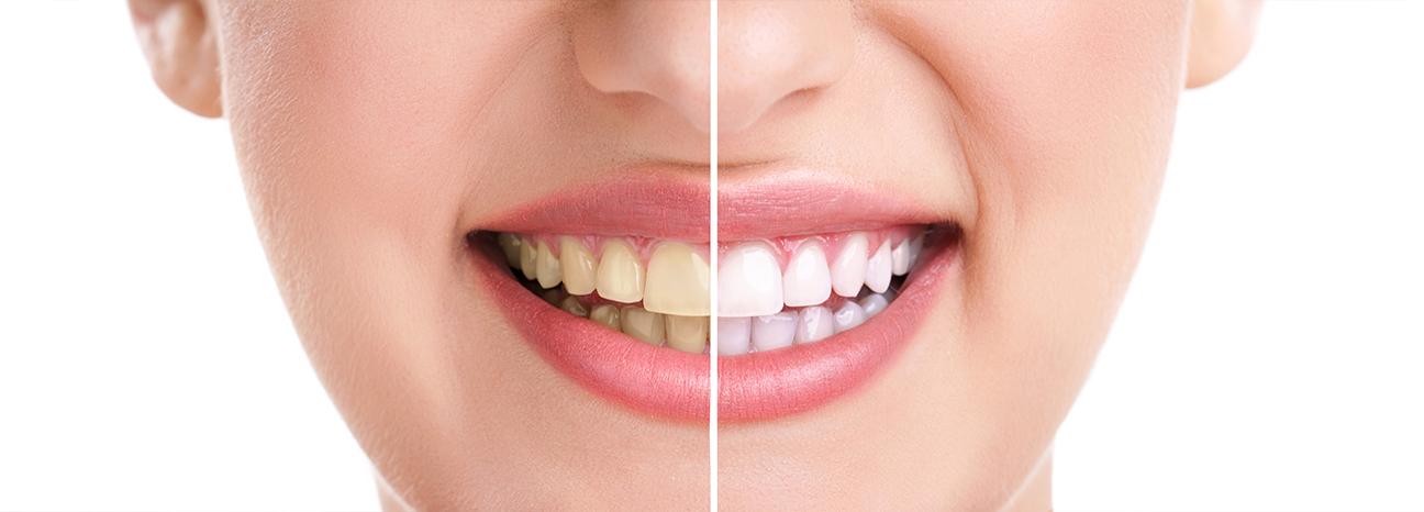 Teeth Whitening Treatment | Redtree Dental | Vancouver General Dentist
