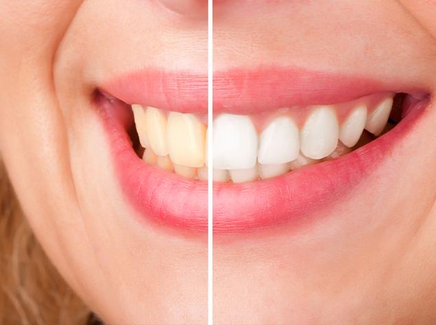 Teeth Whitening Redtree Dental General and Family Dentist Vancouver | Redtree Dental