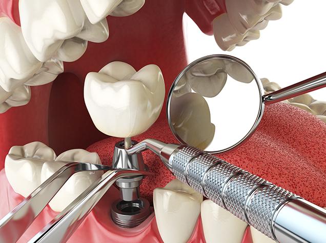 The Dental Implant Surgical Process | Redtree Dental | Vancouver General & Family Dentist