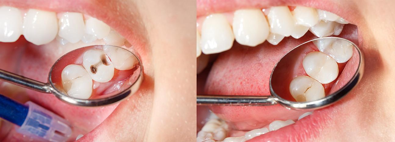 Tooth Colour Match Fillings | Redtree Dental | Vancouver General Dentist