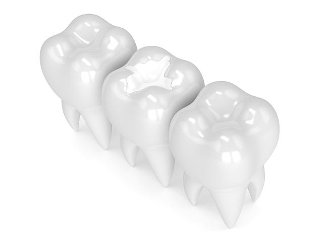 Tooth Colour Match Fillings | Redtree Dental | Vancouver General Dentist