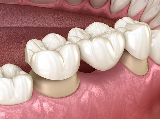 What is a Dental Bridge | Redtree Dental | Vancouver General & Family Dentist