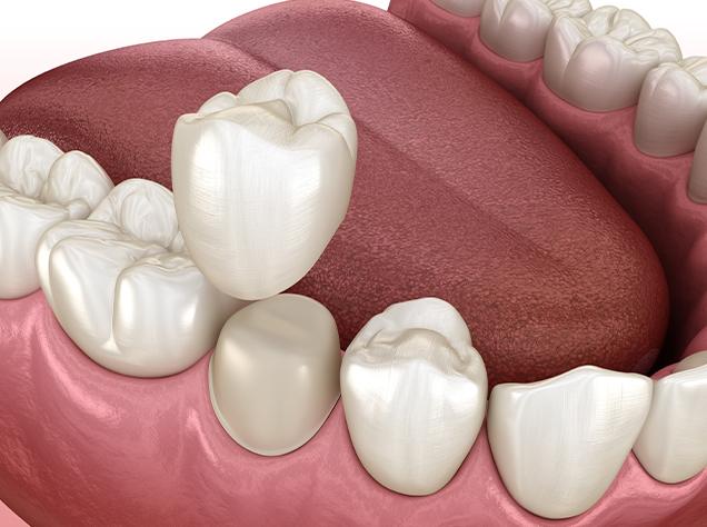 Dental Crowns in Vancouver | Redtree Dental | Vancouver General & Family Dentist