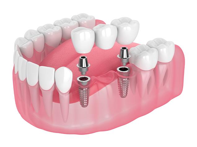 What is a Dental Implant | Redtree Dental | Vancouver General & Family Dentist