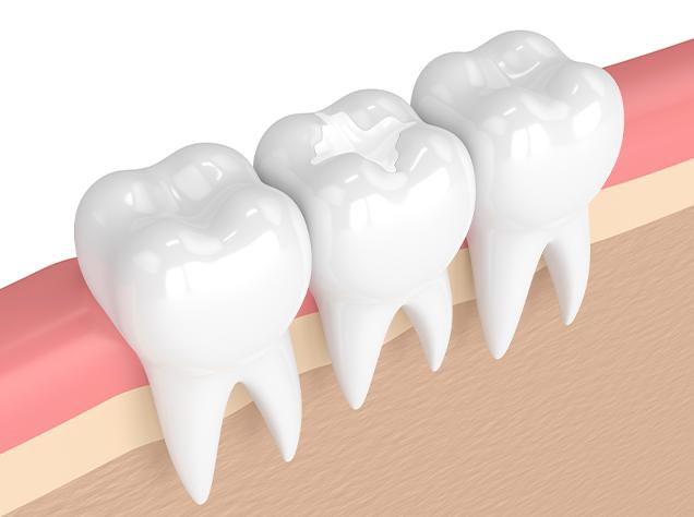 What is a tooth colour match fillings | Redtree Dental | Vancouver General Dentist