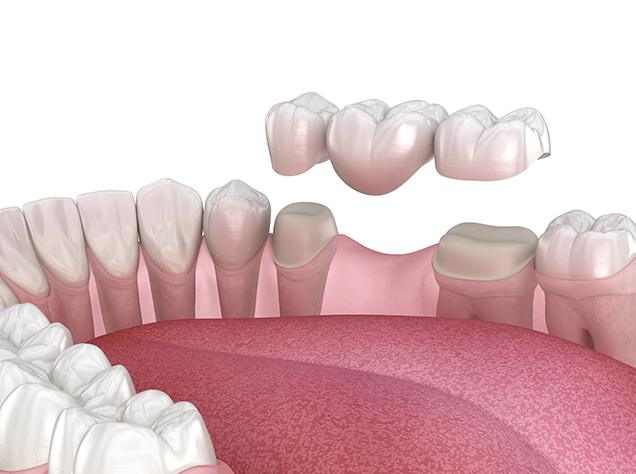 What is Involved in Getting a Dental Bridge | Redtree Dental | Vancouver General Dentist