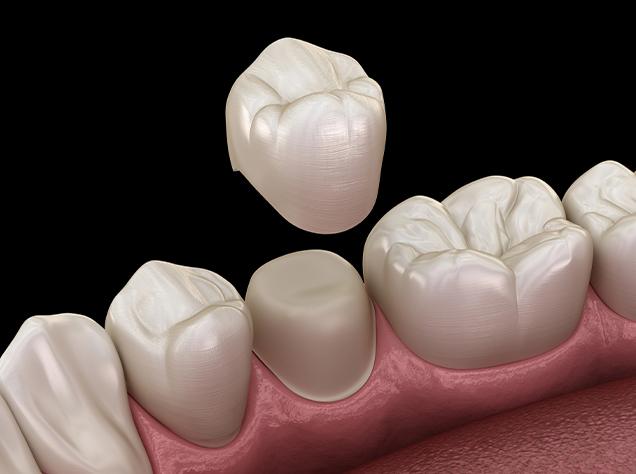 What is the Process of Placing a Dental Crown | Redtree Dental | Vancouver General & Family Dentist