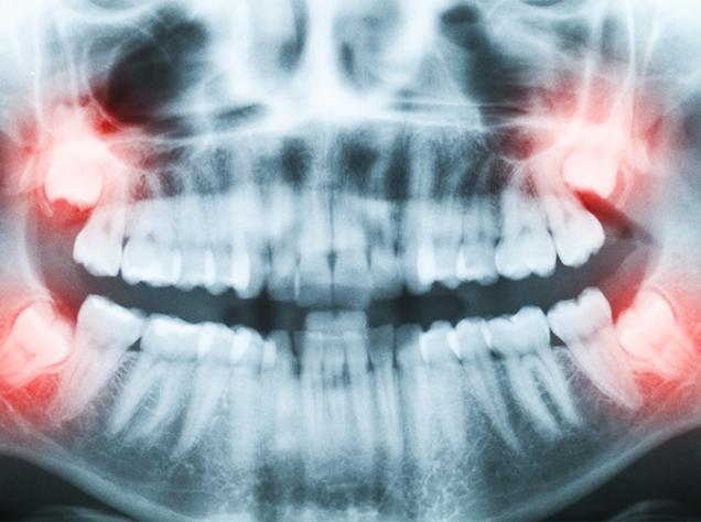 Wisdom Teeth Extractions | Redtree Dental | Vancouver General & Family Dentist