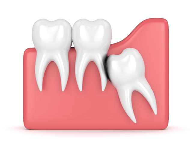 Wisdom Teeth Extractions | Redtree Dental | Vancouver General & Family Dentist