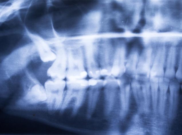 Wisdom Teeth Extractions | Redtree Dental | Vancouver General & Family Dentist