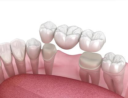 Vancouver Dental Bridges | Redtree Dental | Vancouver General & Family Dentist