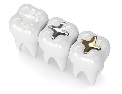 Dental Fillings | Redtree Dental | Vancouver General & Family Dentist
