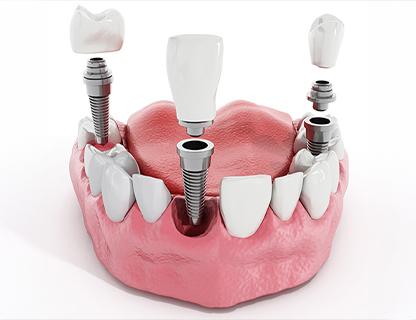 Dental Implants | Redtree Dental | Vancouver General & Family Dentist