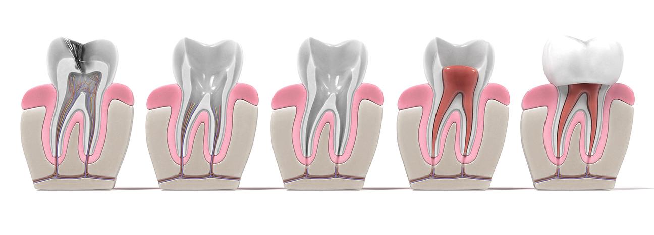 Fontana Light Walker Dental Implants | Redtree Dental | Vancouver General & Family Dentist