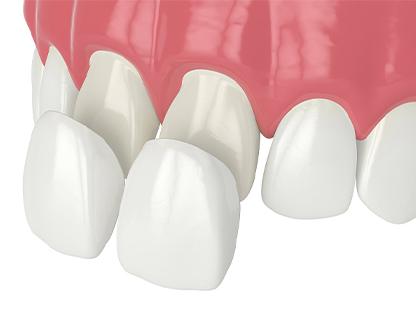 Vancouver Porcelain Veneers | Redtree Dental | Vancouver General & Family Dentist