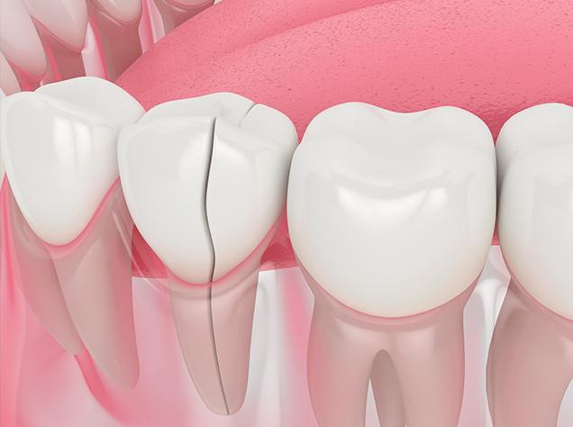 Restorative Dentistry | Redtree Dental | Vancouver General Dentist