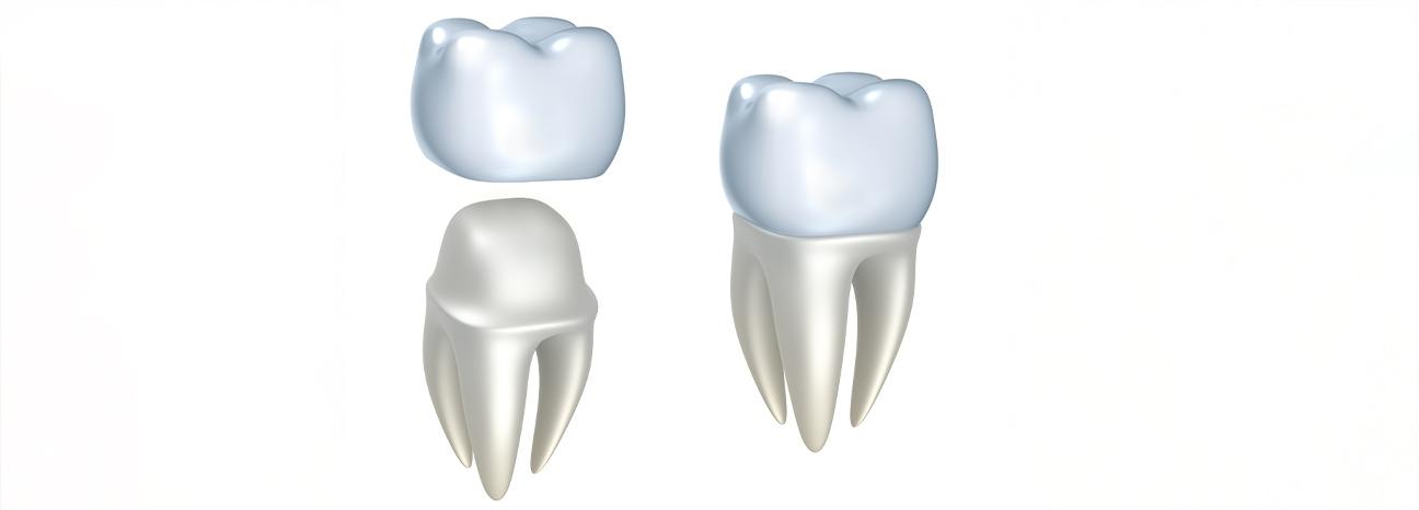 Vancouver Restorative Dentistry | Redtree Dental | Vancouver General & Family Dentist