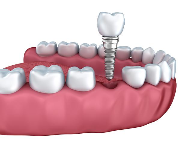 Vancouver Restorative Dentistry | Redtree Dental | Vancouver General Dentist