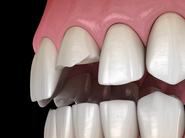 Smile Makeover | Redtree Dental | Vancouver General & Family Dentist