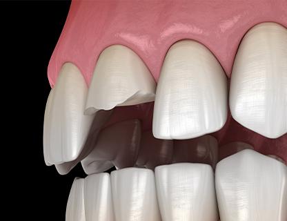 Smile Makeover | Redtree Dental | Vancouver General & Family Dentist