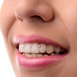 Invisalign Propel