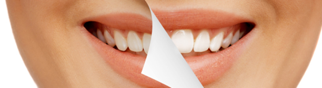 Smile Makeover Techniques